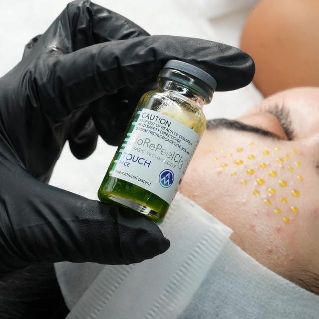 Biorepeel x 4 sessions 